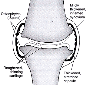 Mild osteoarthritis knee joint diagram